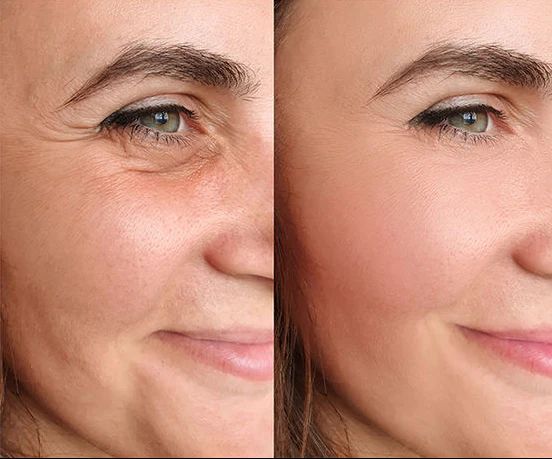 Before and after — under-eye bags