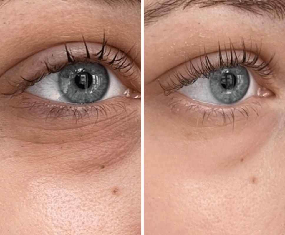 Before and after — fine lines